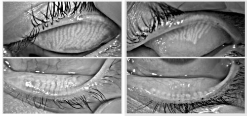 Meibomian glands
