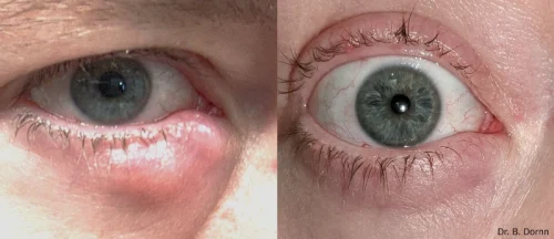 lumecca-forma-i-before-after-dr-b-dornn-preview-1
